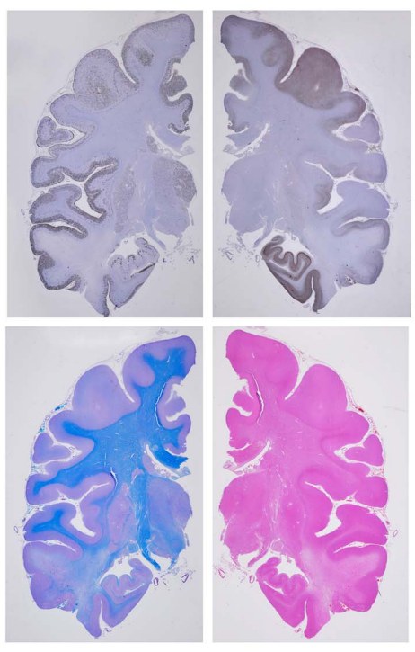 1 Neurodegenerative Diseases