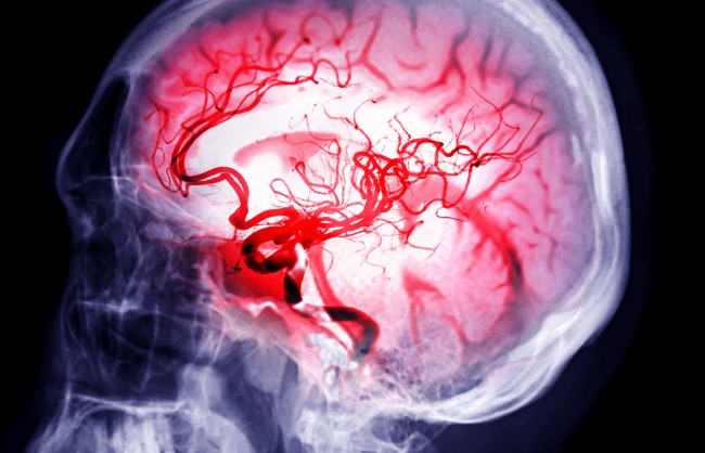 Cerebrovascular Diseases