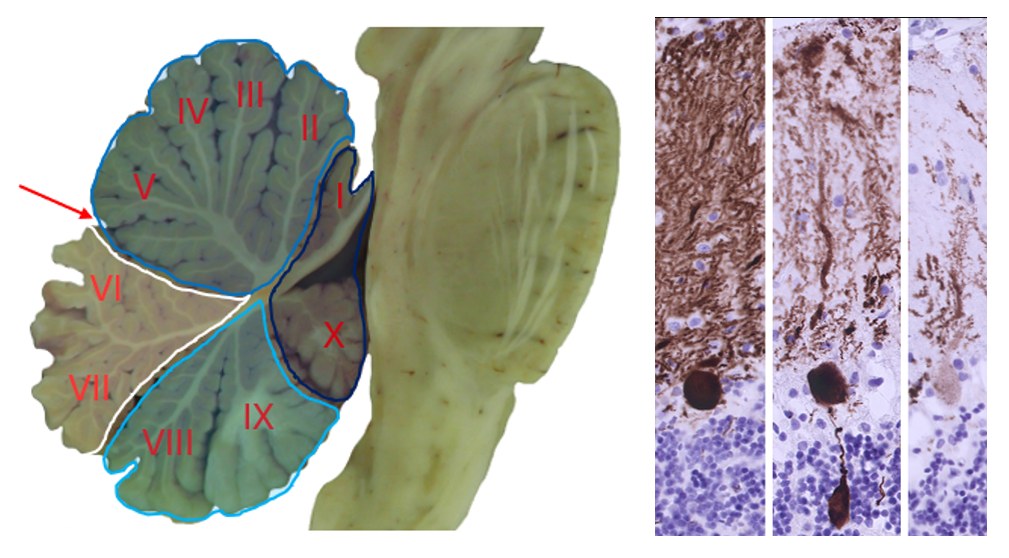 2 Ataxic Disorders